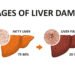 New Drug Resmetirom for Non-Alcholic SteatoHepatitis